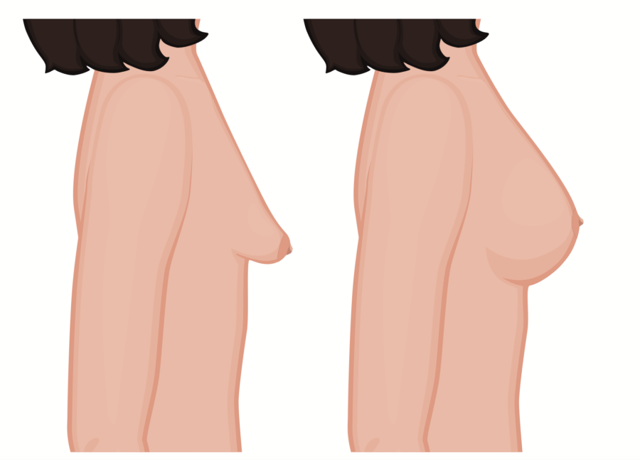 Correction des seins tubéreux à paris