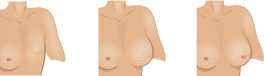 Chirurgie reconstructrice du sein après mastectomie en clinique esthétique
