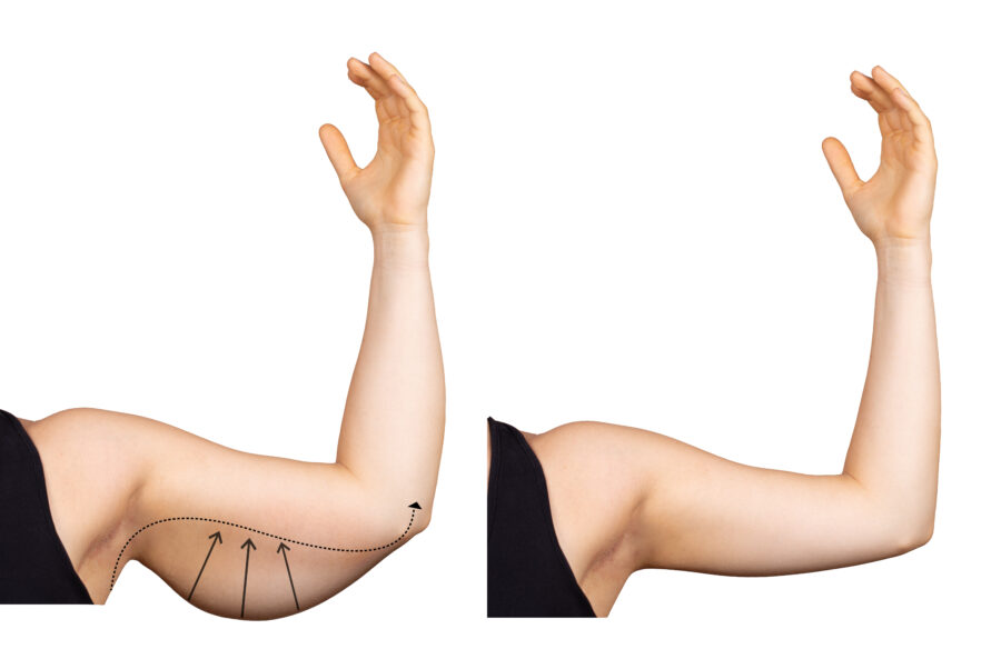 Lifting des bras par brachioplastie lipoaspiratio