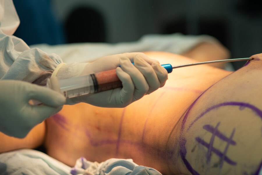 Intervention de lipofilling des seins par un chirurgien esthétique