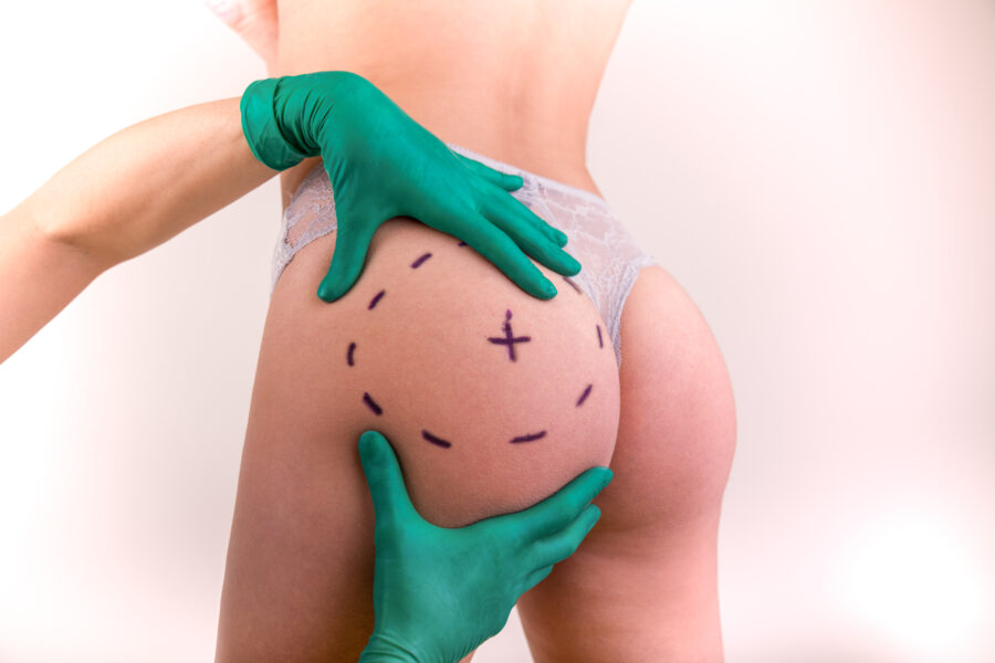 Intervention implants fessiers par un chirurgien esthetique