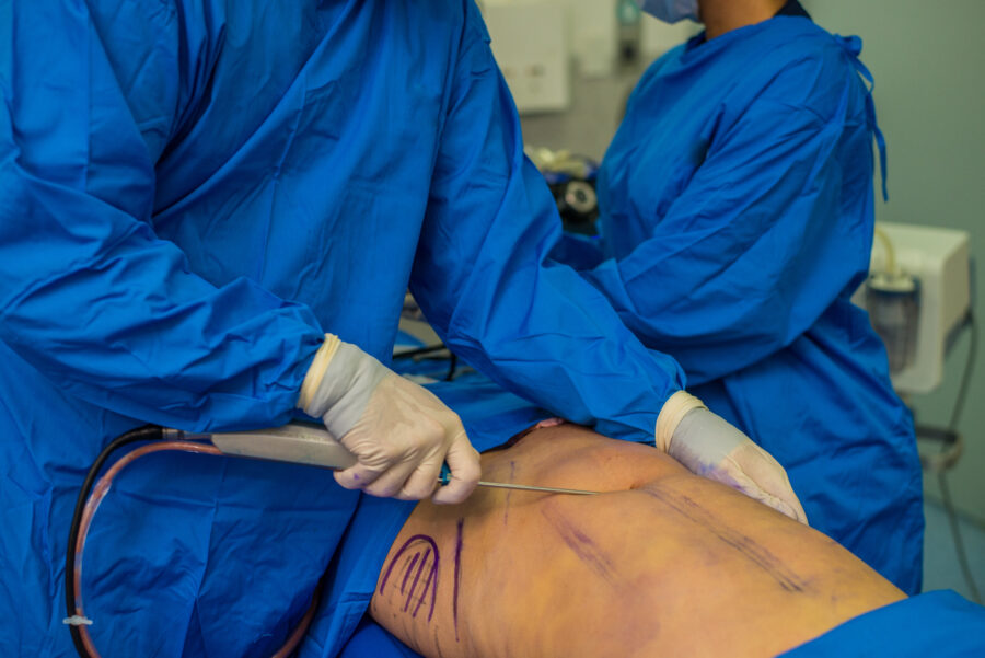 Abdominal ecthing a paris par liposculpture