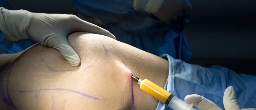 Chirurgie de la silhouette par lipofilling des fesses : brazilian butt lift