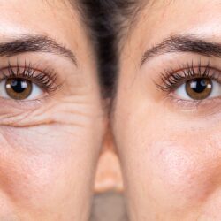 Blepharoplasty in Paris — Facial surgery, Rive Droite Paris Étoile practice