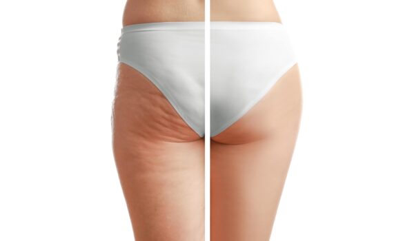 Body-contouring surgery in Paris — liposuction, abdominoplasty and body lift