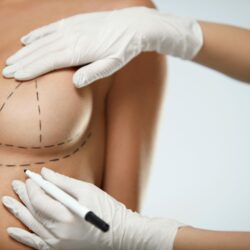 Breast lift in Paris — Breast surgery, Rive Droite Paris Étoile practice