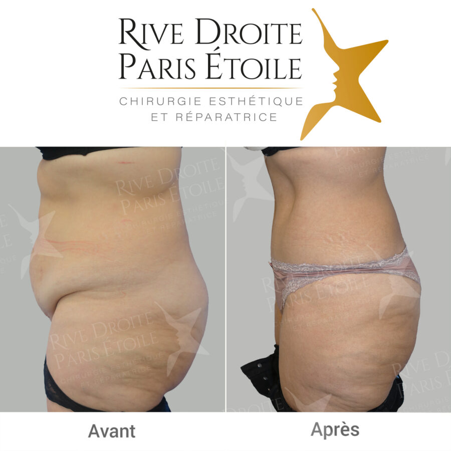 before and after abdominoplasty in Paris