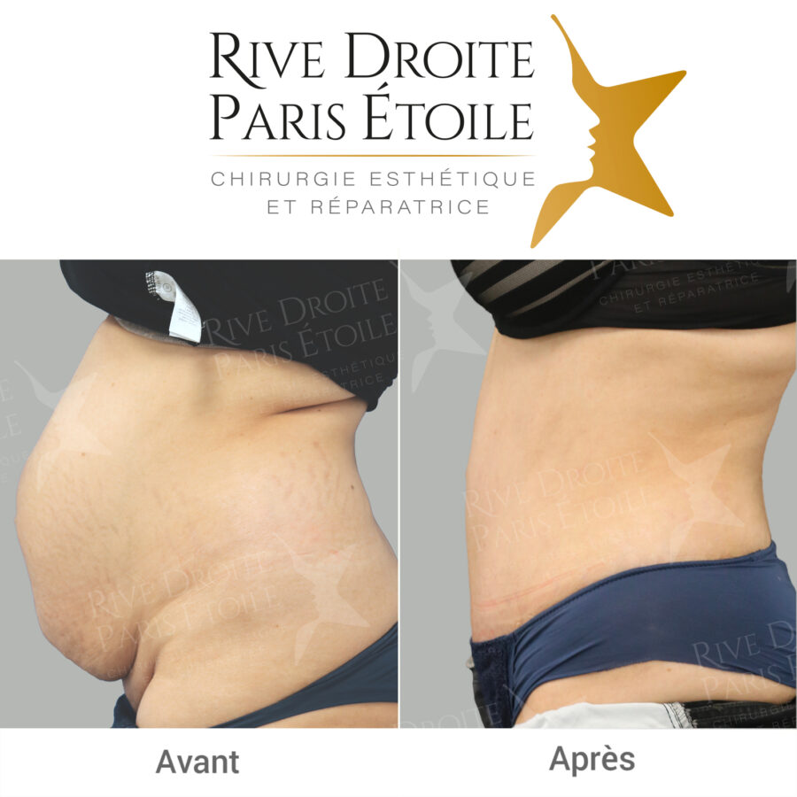 Abdominoplasty in Paris — before / after result of an abdominal plasty with diastasis repair