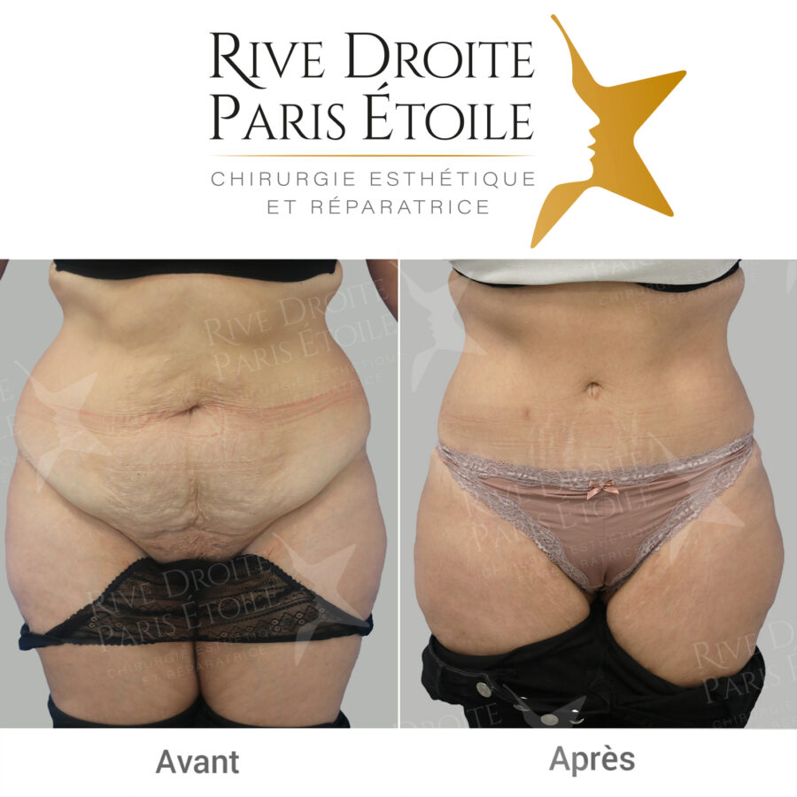 before and after abdominoplasty in Paris