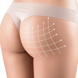 Brazilian Butt Lift (BBL) in Paris — Buttock surgery, Rive Droite Paris Étoile practice