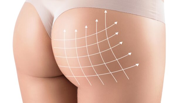 Buttock surgery in Paris — BBL, buttock implants and buttock lift