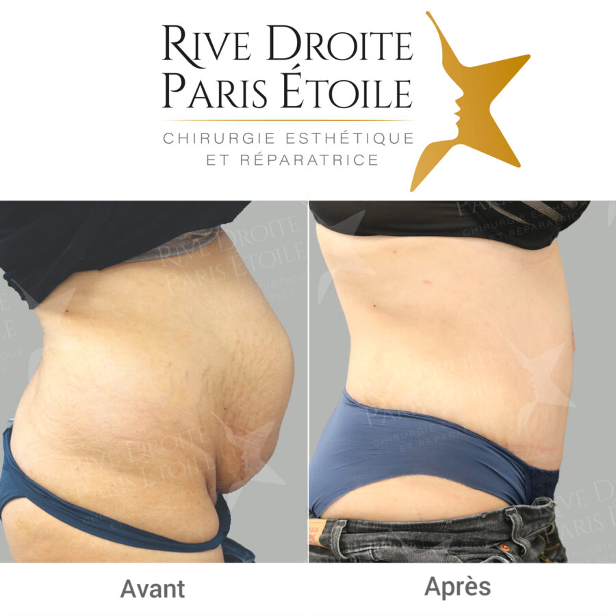 before and after abdominoplasty in Paris
