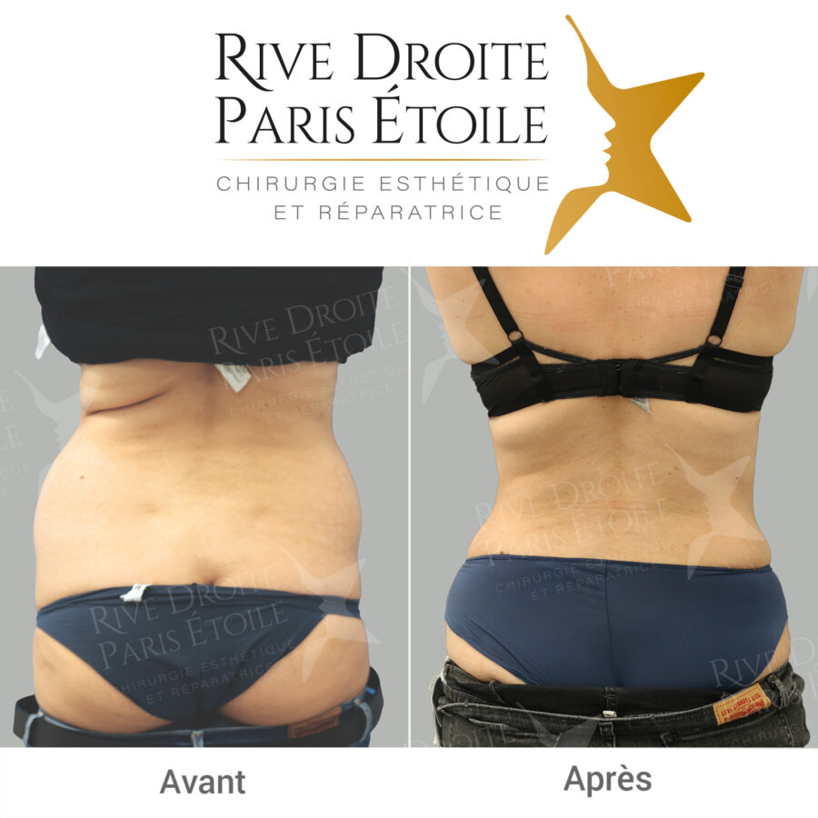 before and after abdominoplasty in Paris