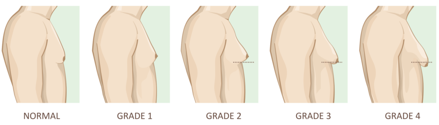 Opération gynecomastie homme paris