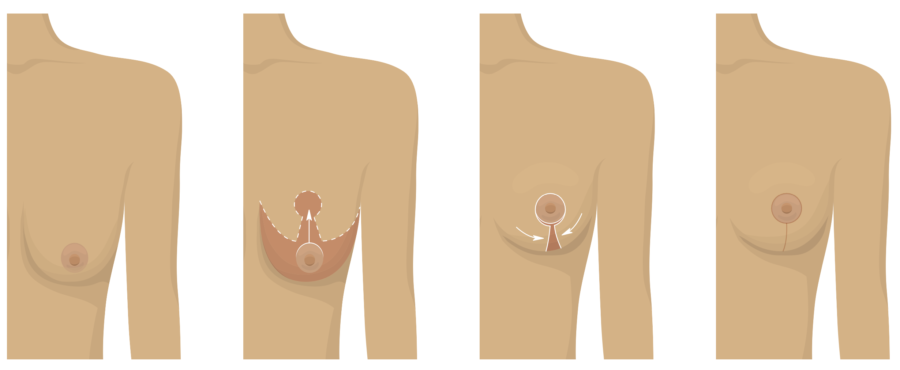 Breast ptosis: diagnosis before a breast lift in Paris