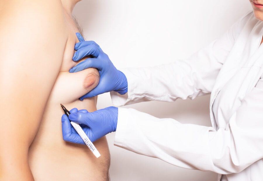 Intervention chirurgicale gynecomastie paris