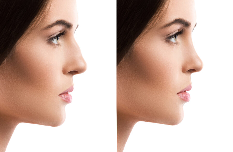 Opération rhinoplastie correction du nez par un chirurgien esthétique