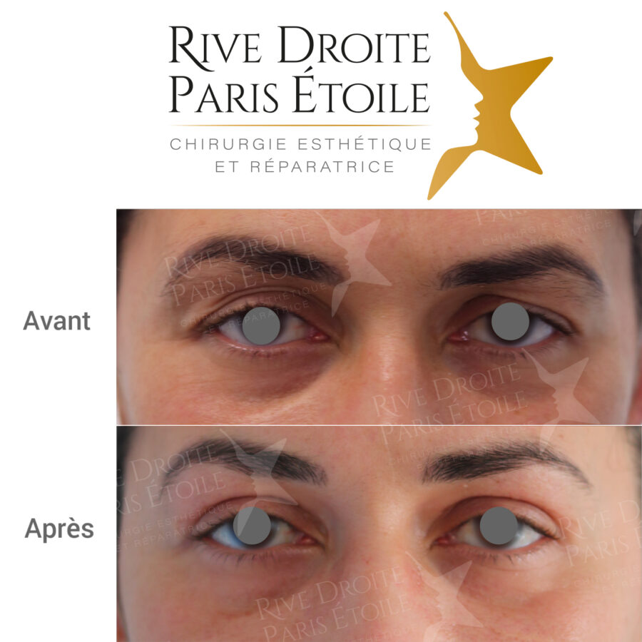 before and after blepharoplasty (eyelid surgery) in Paris