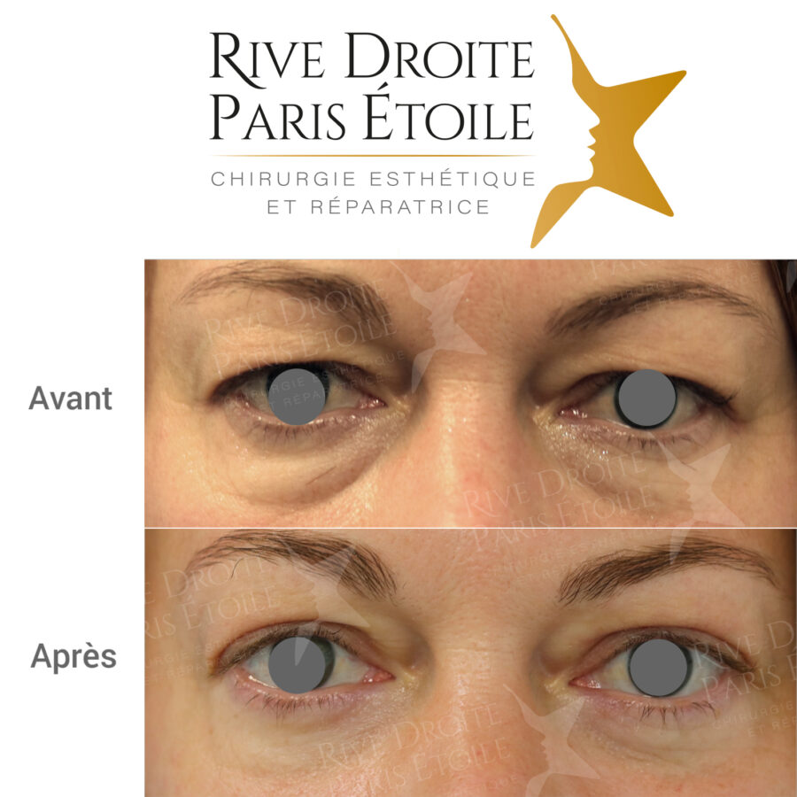 before and after blepharoplasty (eyelid surgery) in Paris