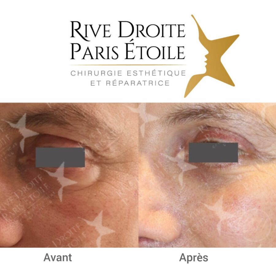 before and after blepharoplasty (eyelid surgery) in Paris