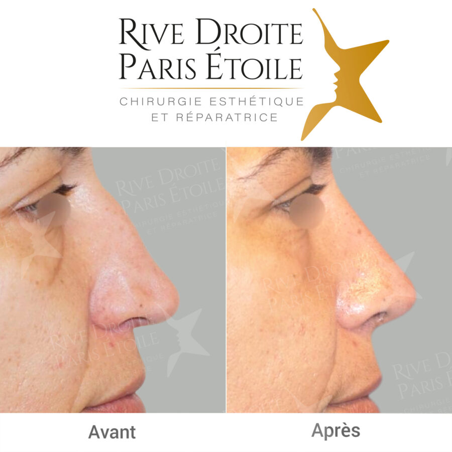 before and after rhinoplasty in Paris