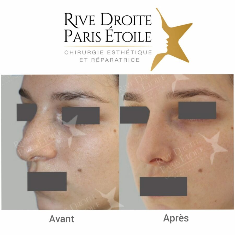 before and after rhinoplasty in Paris