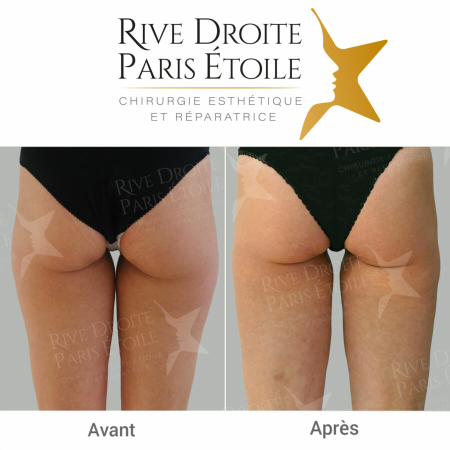 before and after thigh liposuction in Paris