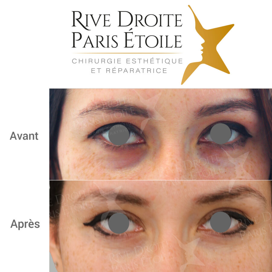 before and after under-eye hollows treatment in Paris
