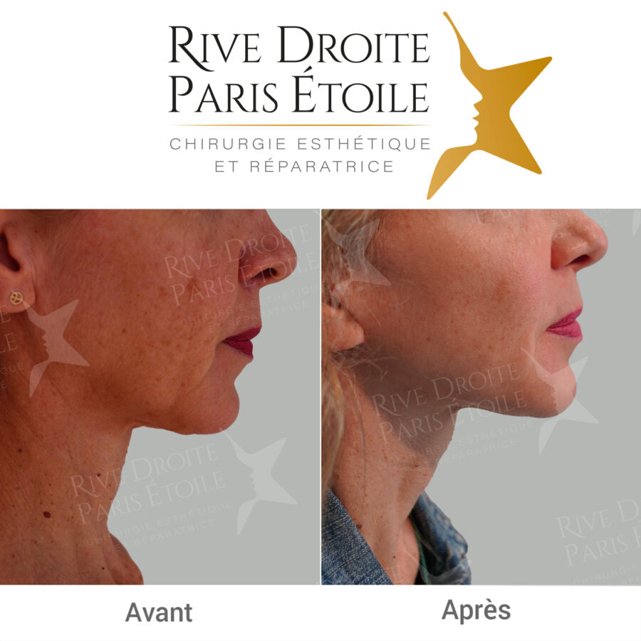 Facelift in Paris — before / after photo of a cervicofacial lift