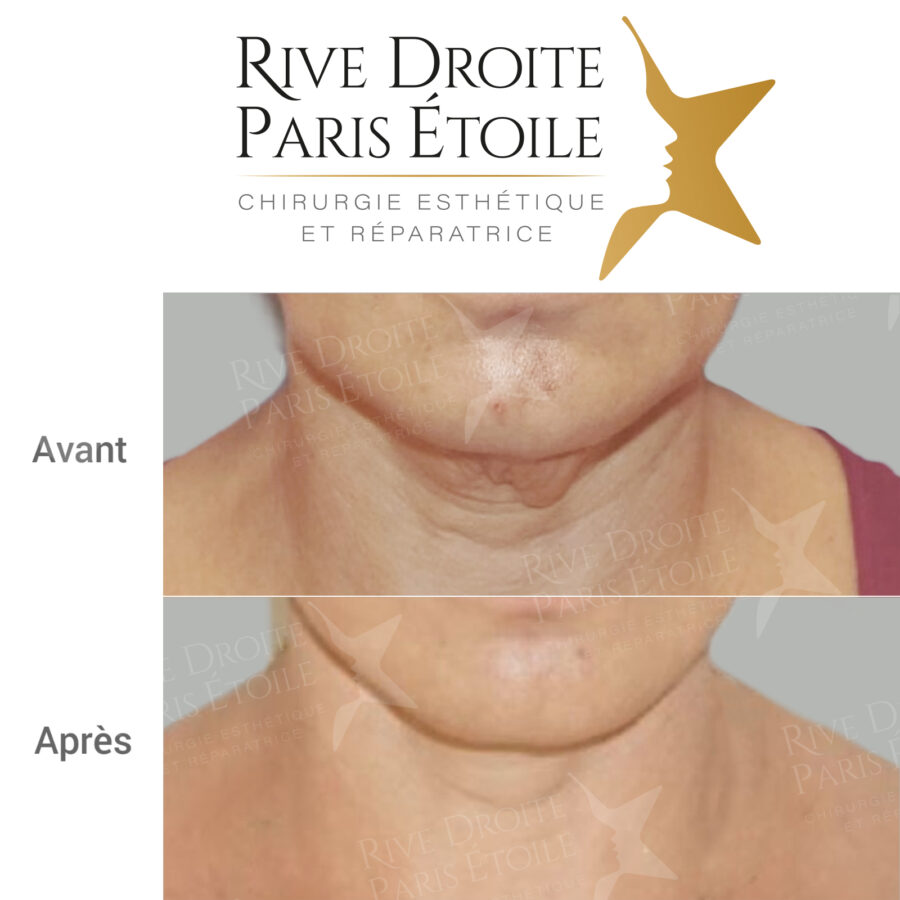 before and after facelift in Paris