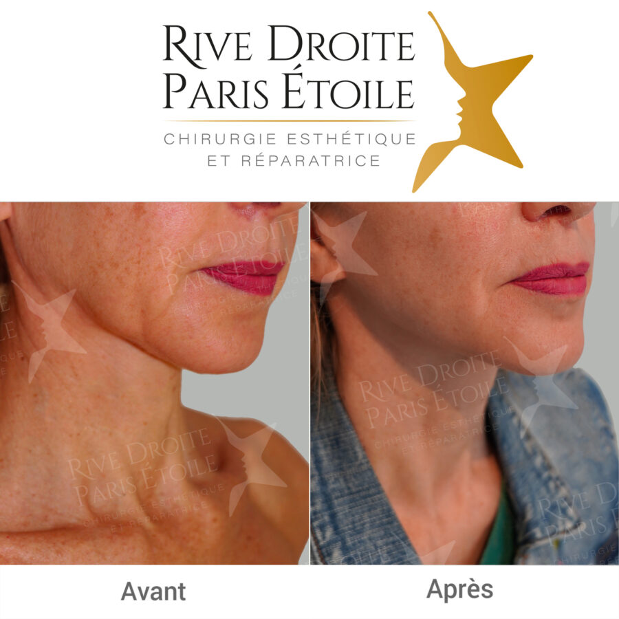 before and after facelift in Paris