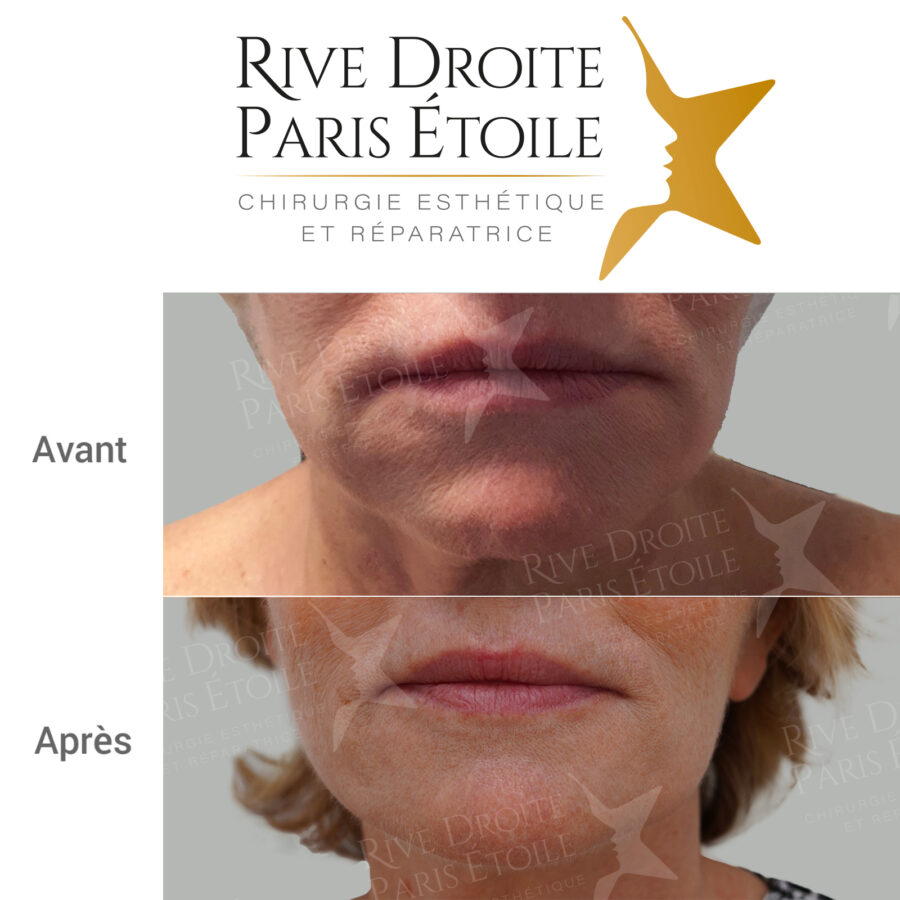 before and after facelift in Paris