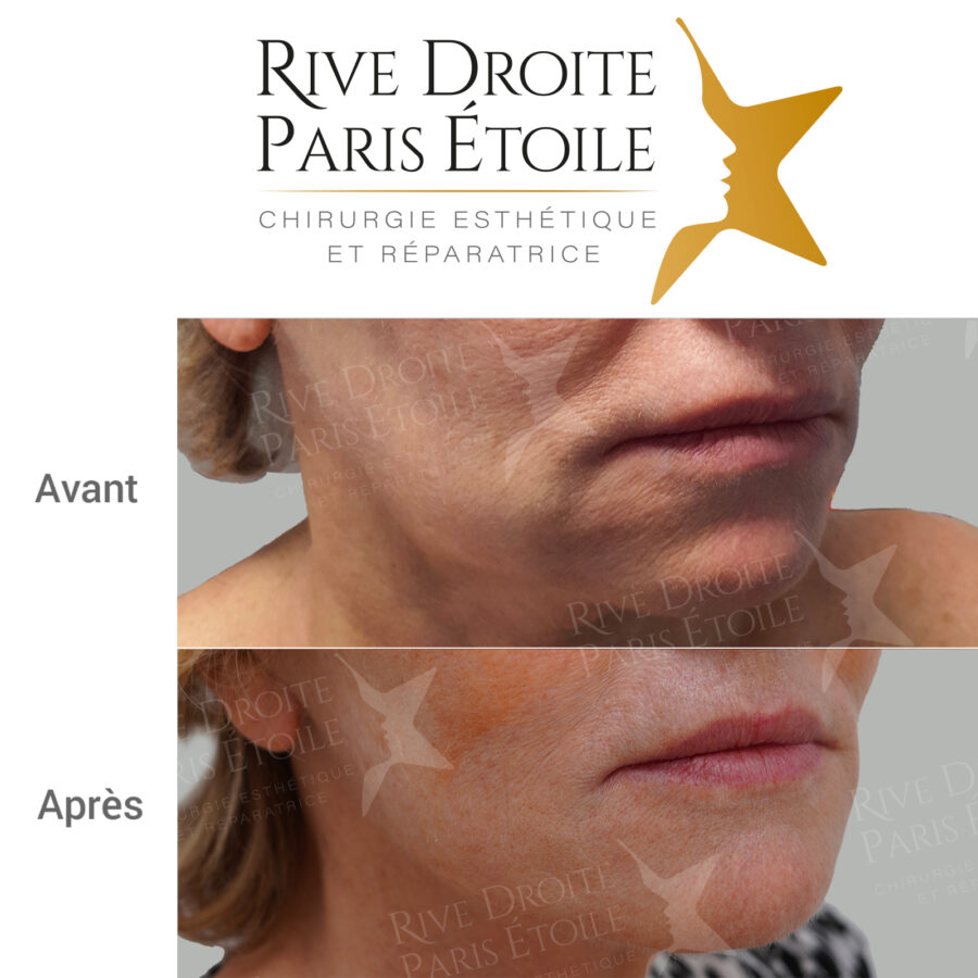 before and after facelift in Paris