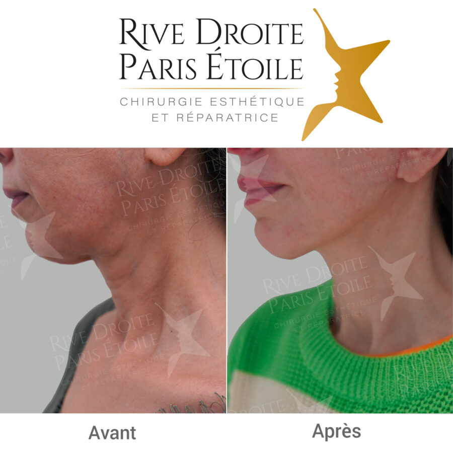 before and after facelift in Paris