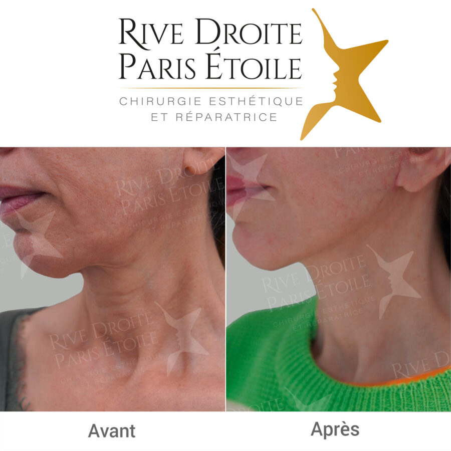 before and after facelift in Paris