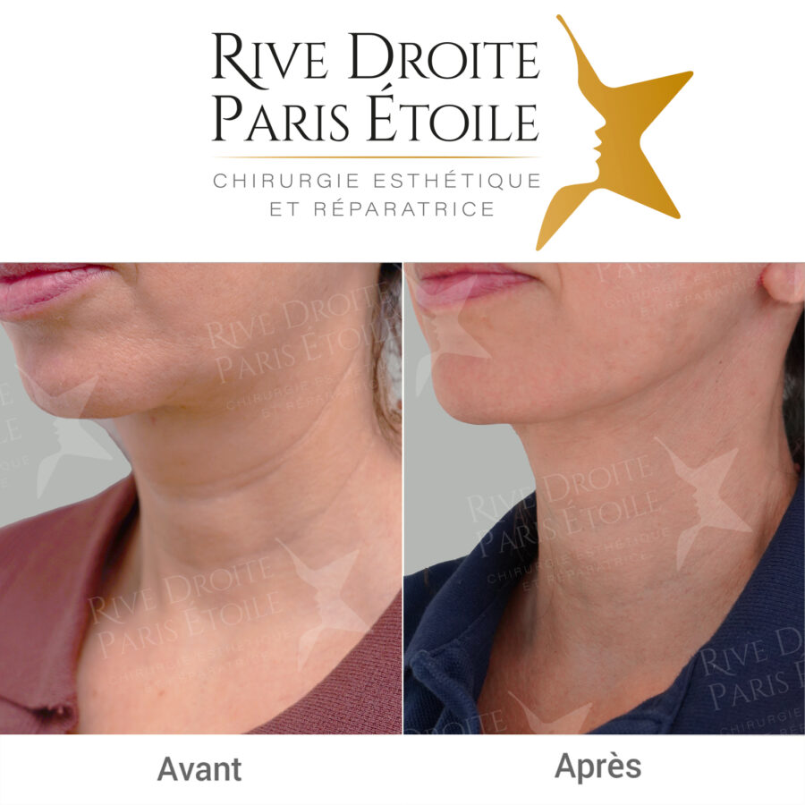 before and after facelift in Paris