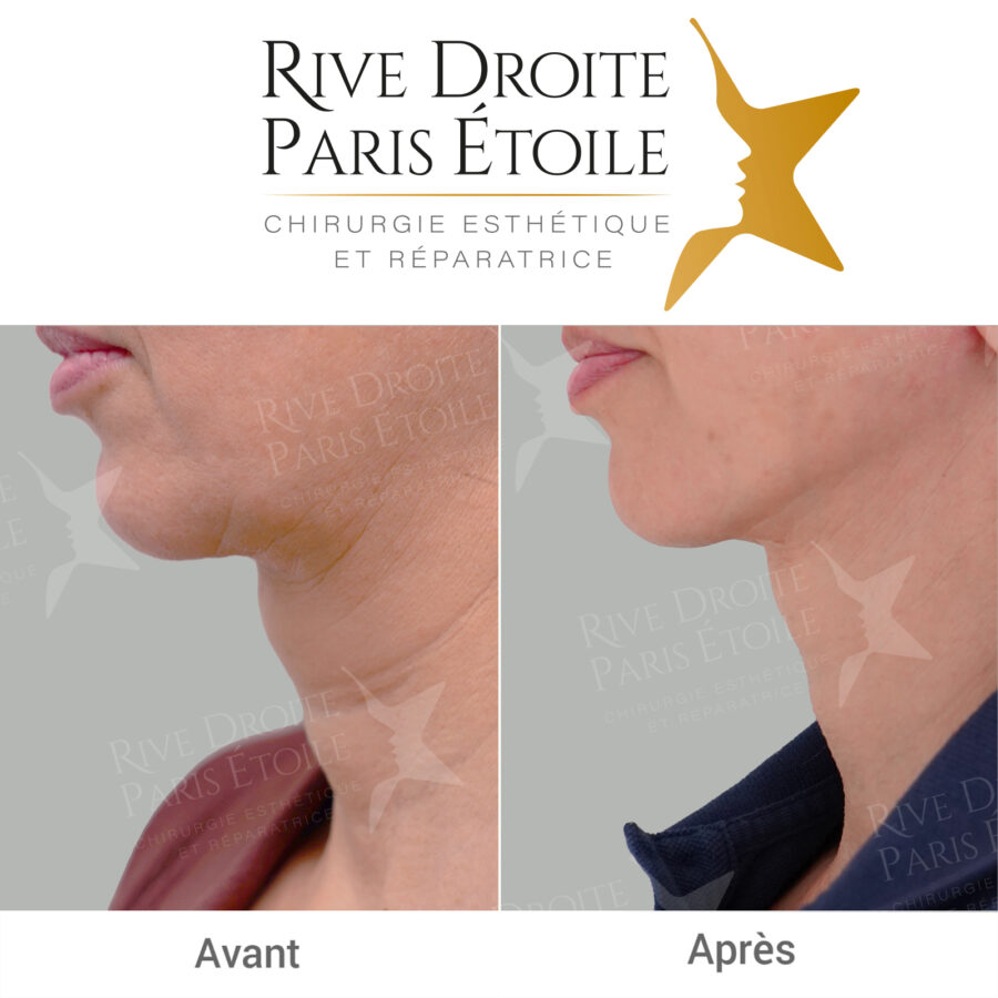 before and after facelift in Paris