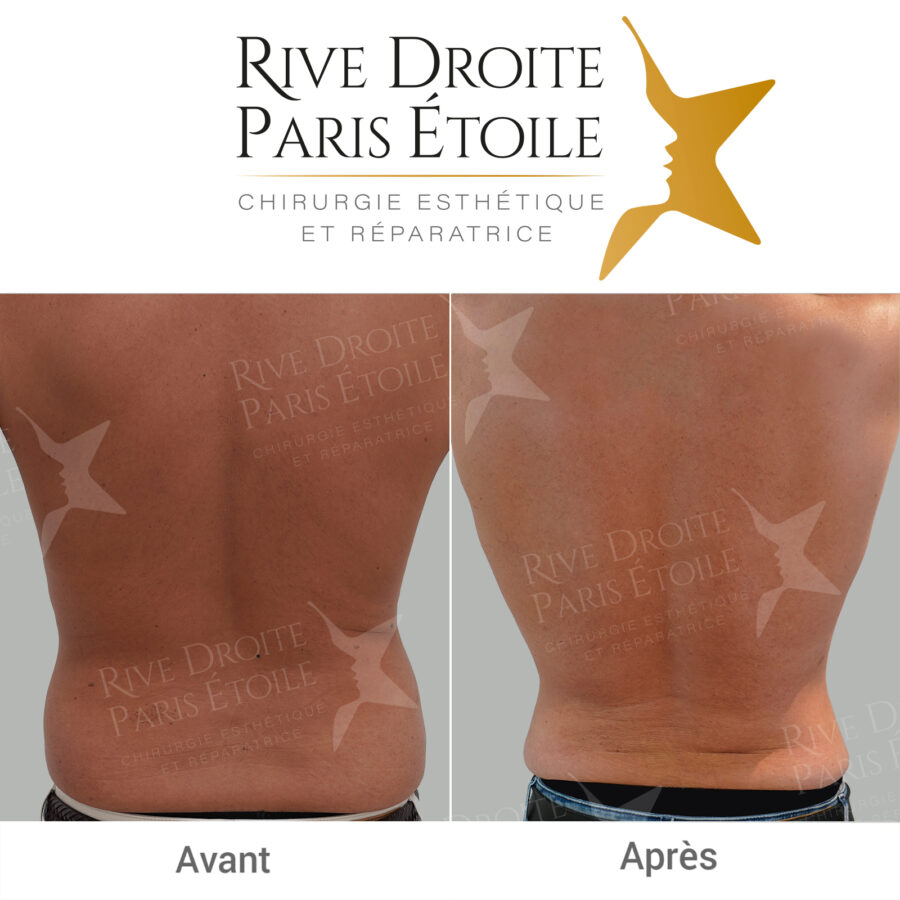 before and after back liposuction in Paris