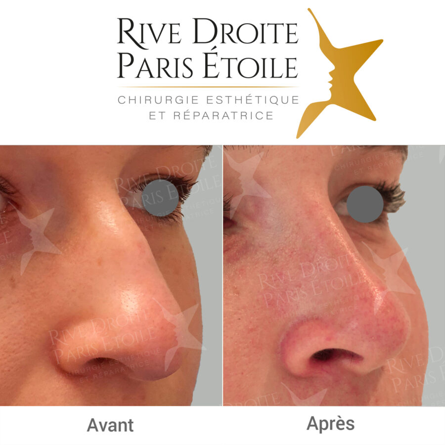 before and after rhinoplasty in Paris
