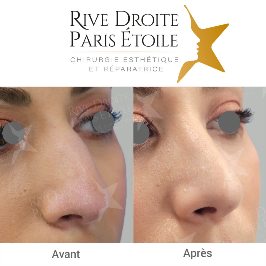 before and after rhinoplasty in Paris