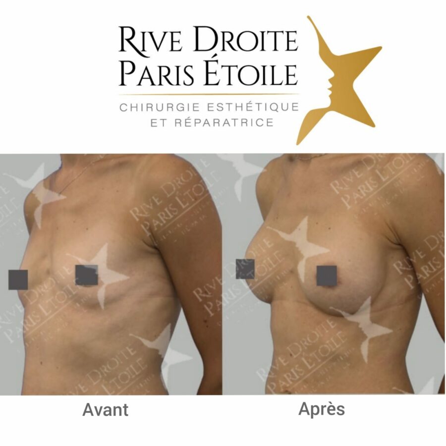 before and after breast implants in Paris