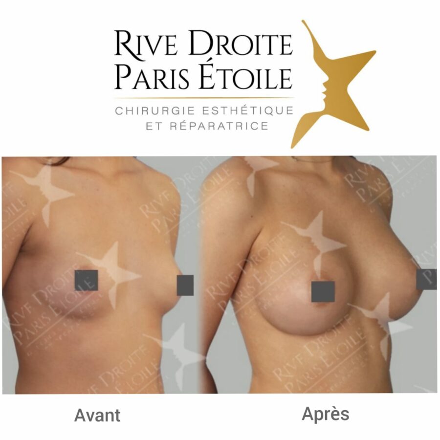 before and after breast implants in Paris