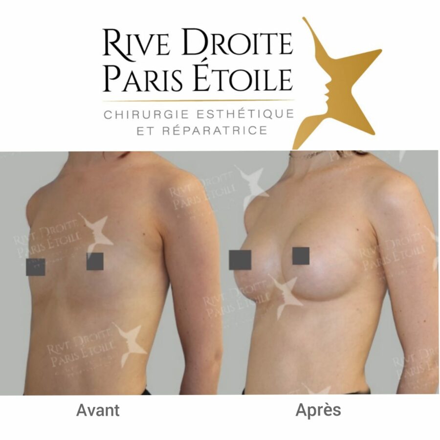 before and after breast implants in Paris