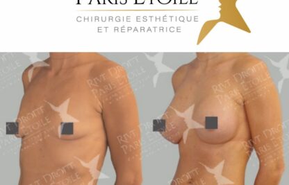avant après Prothèses mammaires à Paris