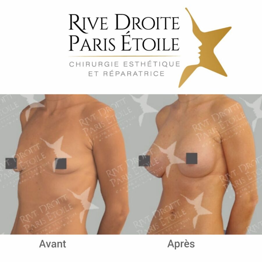 before and after breast implants in Paris