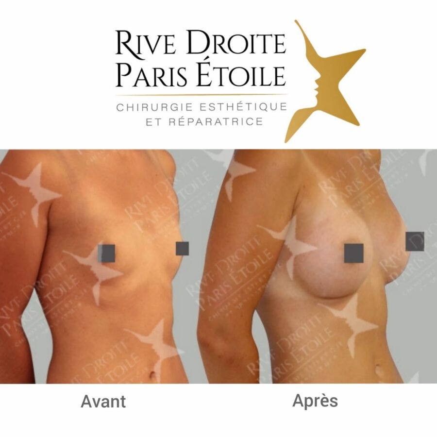 before and after breast implants in Paris
