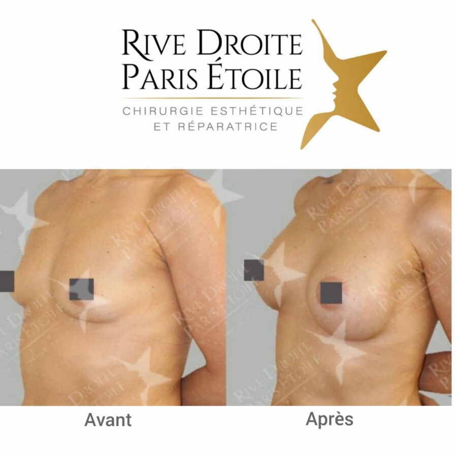 before and after breast implants in Paris