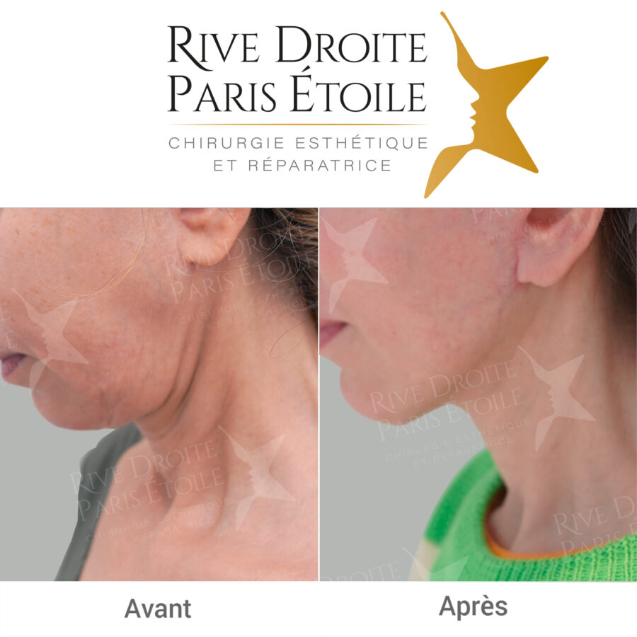 before and after facelift in Paris