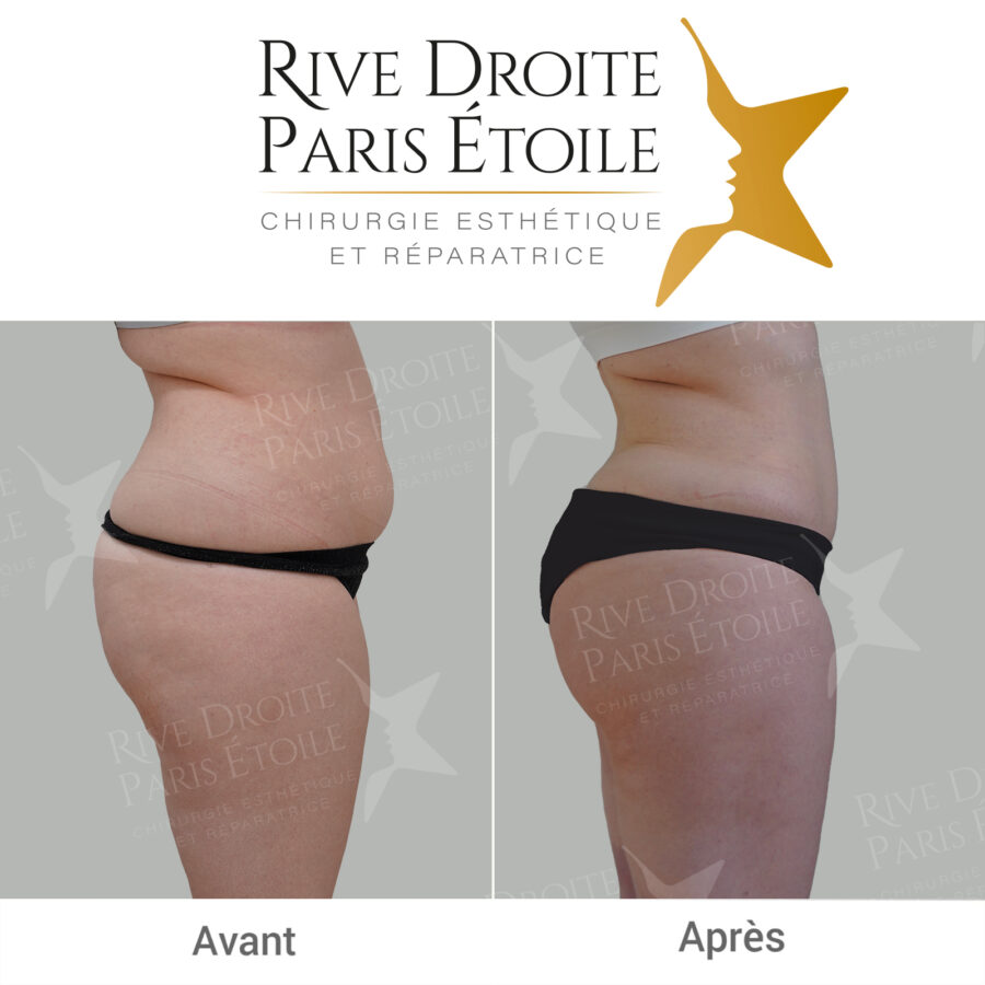 before and after thigh liposuction in Paris