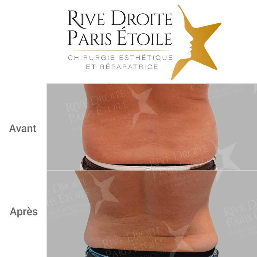 before and after back liposuction in Paris